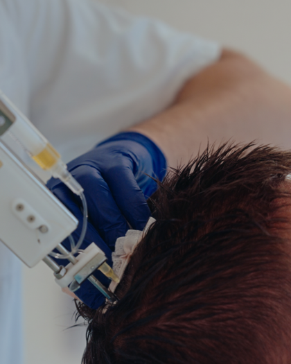 BIG-Arts voert een CTS behandeling uit bij een klant die een FUE-CT haartransplantatie is ondergaan.