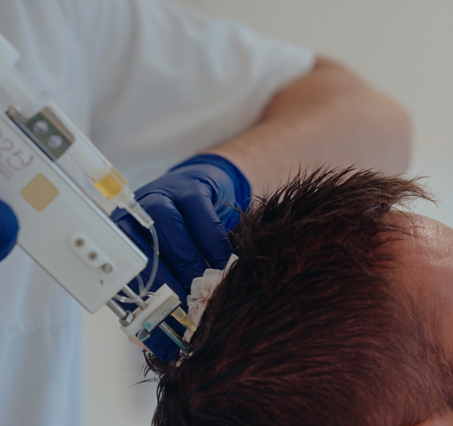 BIG-Arts voert een CTS behandeling uit bij een klant die een FUE-CT haartransplantatie is ondergaan.