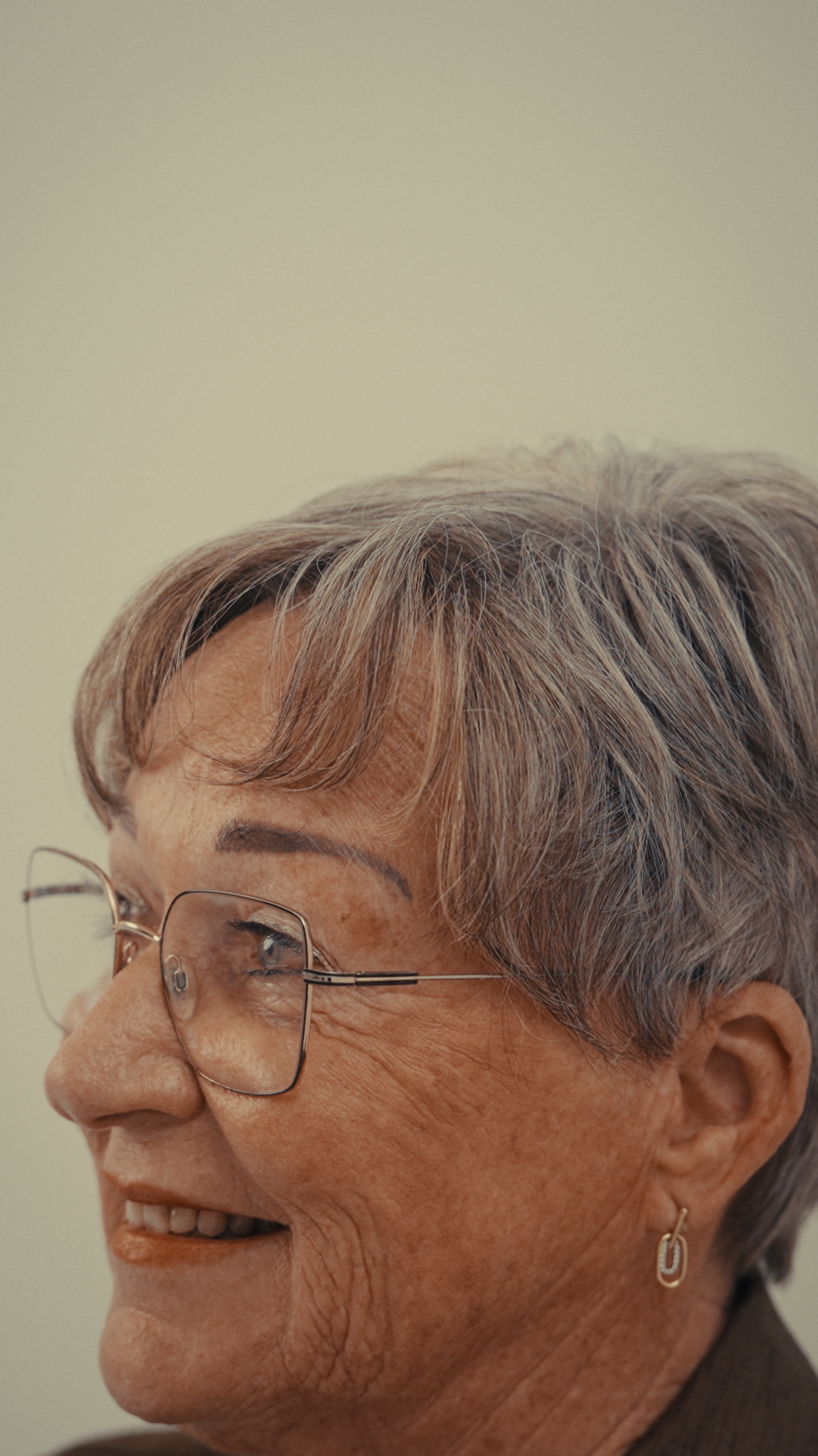 Zijaanzicht – natuurlijke haarlijn overgang zijaanzicht haartransplantatie vrouw 75 natuurlijke overgang haarlijn FUE CT