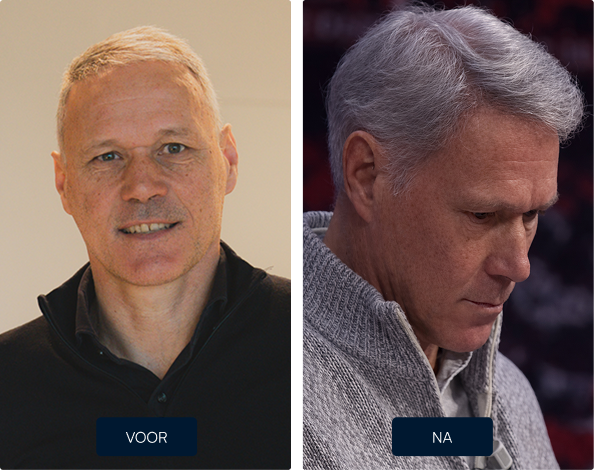 Resultaat hersteloperatie haartransplantatie Marco van Basten na FUE CT behandeling bij Amsterdam Hair Institute