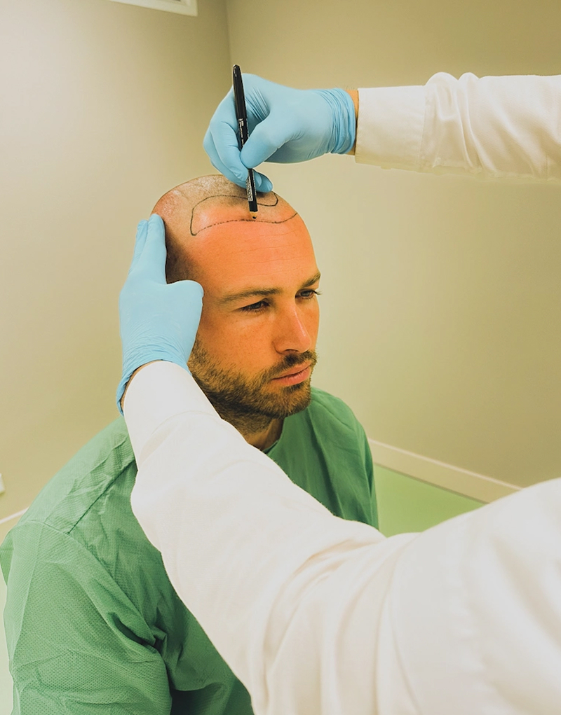 Haarlijnanalyse van Dave Roelvink voorafgaand aan een FUE CT haartransplantatie bij Amsterdam Hair Institute