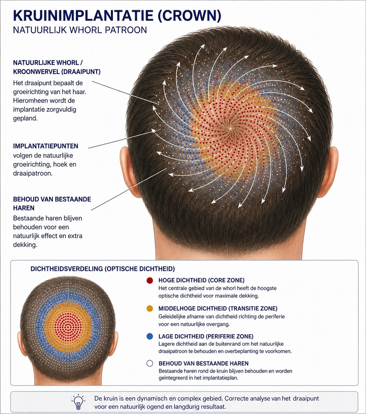 FUE CT Haartransplantatie Kruin (Crown) – Natuurlijk Whorl Patroon Illustratie van een FUE CT haartransplantatie van de kruin met natuurlijk whorl patroon, dichtheidsverdeling en implantatierichting.