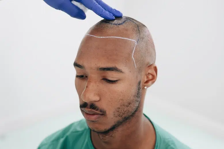 Voorbereiding van de haarlijn bij Kayden Wolff voor een FUE CT haartransplantatie bij kroeshaar en afro haar.