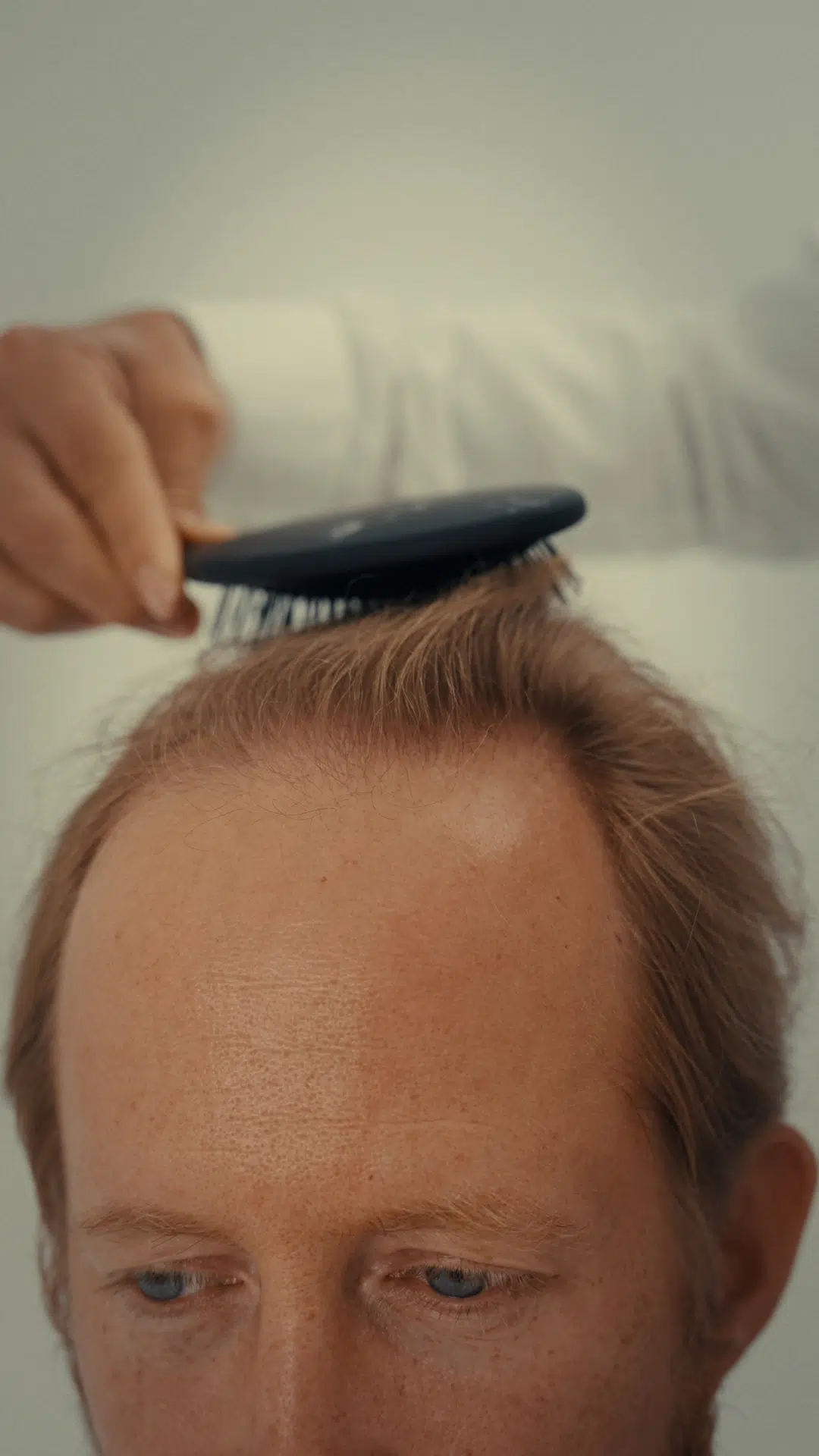 Situatie haarlijn vóór de FUE CT haartransplantatie behandeling van Robert de Hoog bij Amsterdam Hair Institute